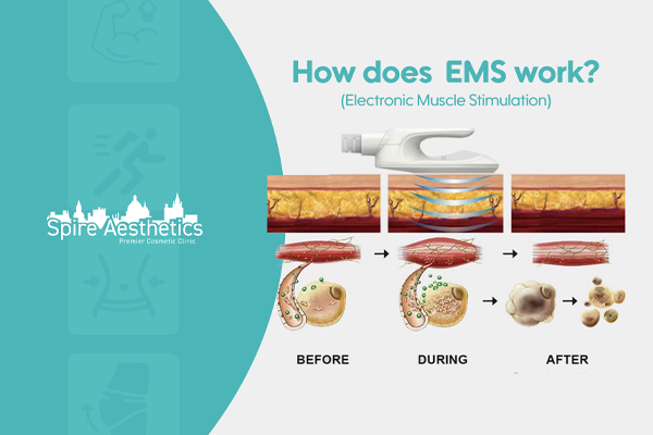 EMS treatment for post pregnancy weight loss treatment Egham