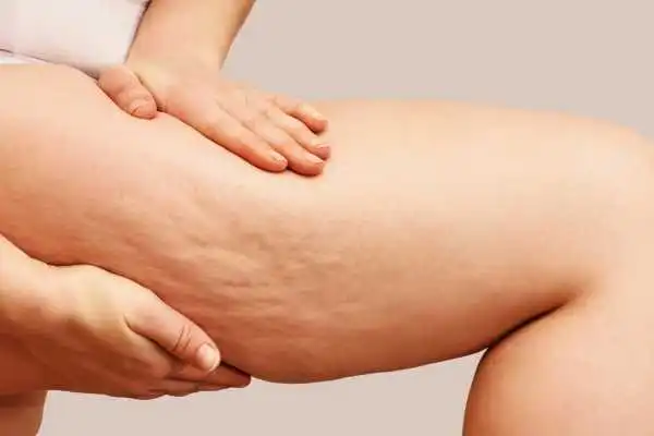Image of woman showing leg with cellulite Egham