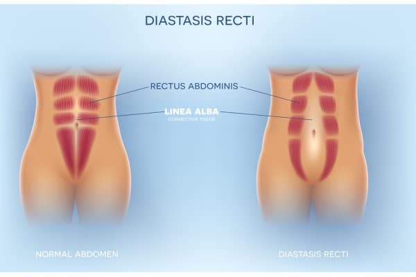 What Non-Surgical Options Are Available for Diastasis Recti Egham?