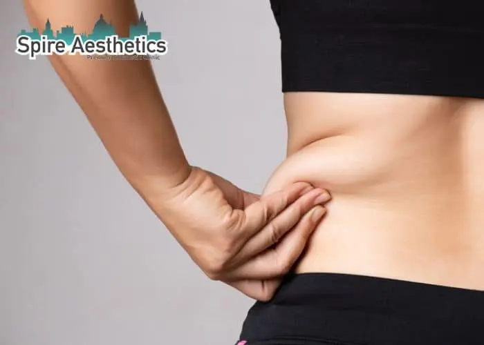 Image of woman pinching fat on their hips Egham. Fat Freezing treatment