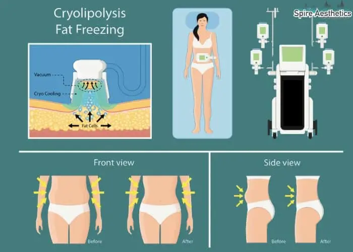 Fat freezing treatment Egham benefits for competitions to remove stubborn fat deposits.