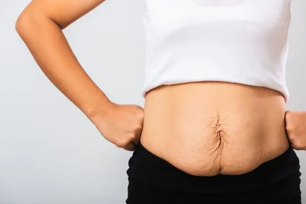 Image of a woman's stomach after weight loss with sagging skin following a gastric band Egham