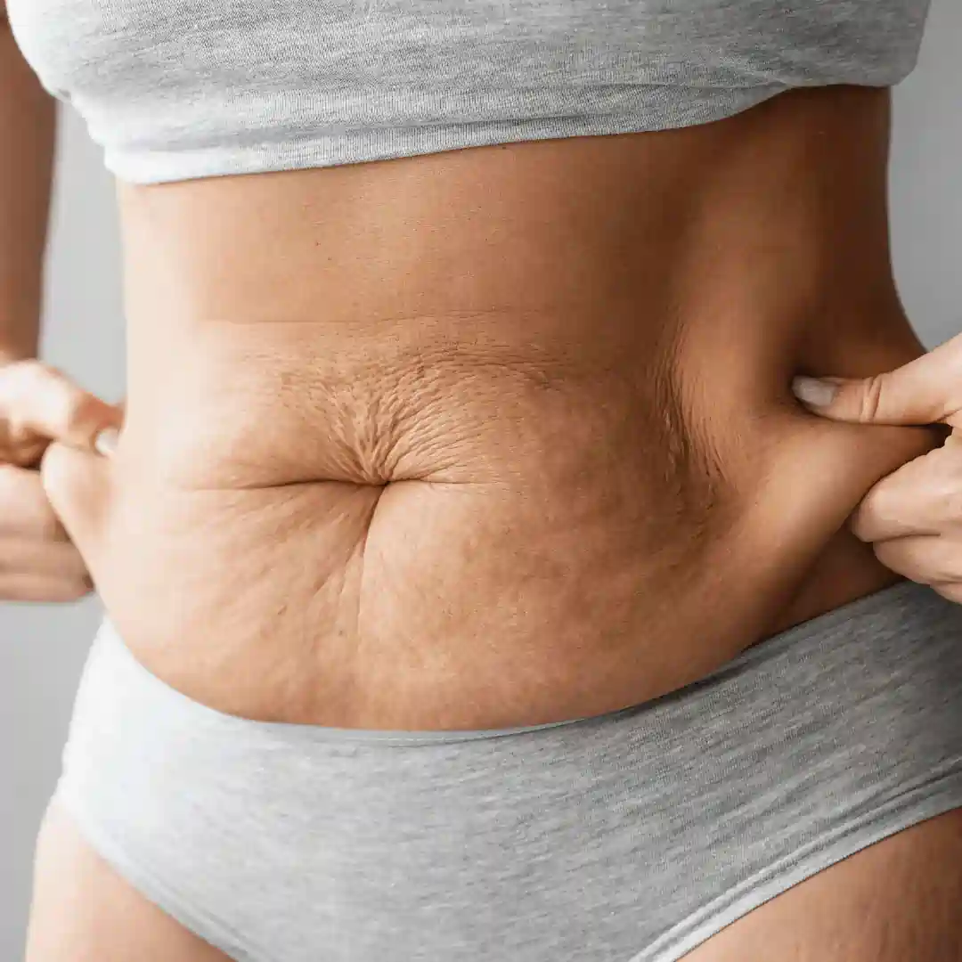 Is It Normal to Have Loose Skin After Pregnancy Egham?