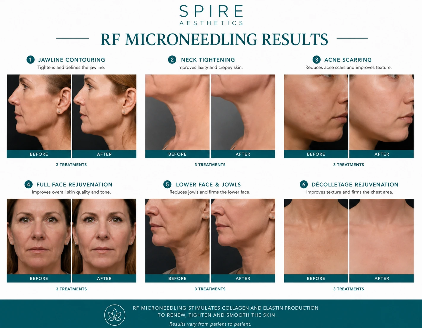 RF Microneedling Skin tightening Egham results