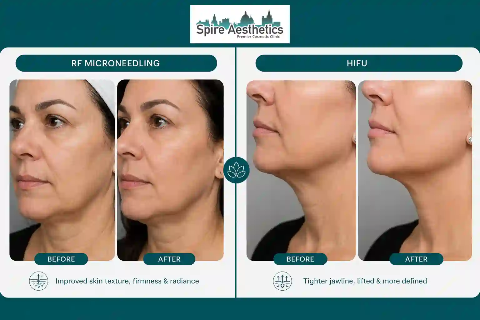 Can RF Microneedling and HIFU Be Combined Egham?