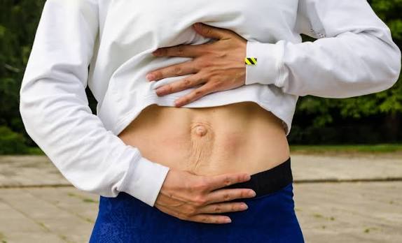 When Could Diastasis Recti Be the Missing Piece of the Puzzle Egham?