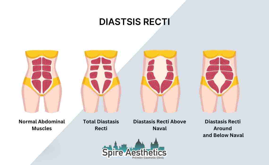 Is Non-Surgical Diastasis Recti Treatment Right for You? Common Concerns Answered Egham